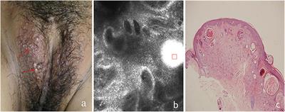 Imaging of Vulva Syringoma With Reflectance Confocal Microscopy